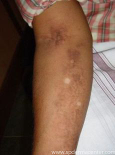 PIH-2 treatments